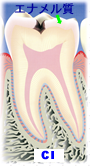 虫歯の段階