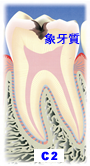 虫歯の段階