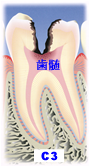 虫歯の段階