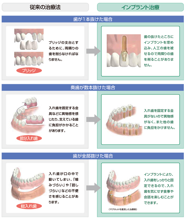 インプラント治療法との比較