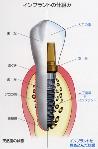 八王子　インプラント