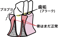 歯周病2