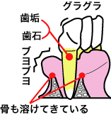 歯周病3