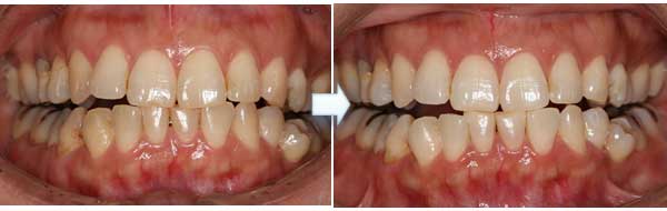 ホワイトニング症例