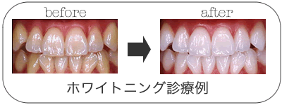 ホワイトニングBA